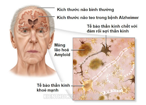 bệnh alzheimer là gì - Kiến Thức Tổng Hợp