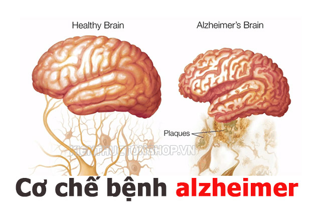 Tìm hiểu về cơ chế gây bệnh alzheimer