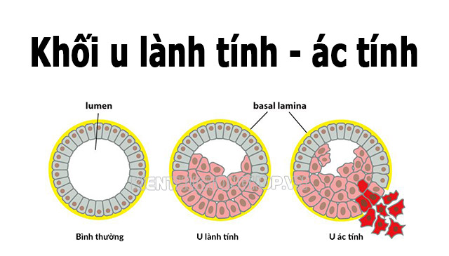 khối u lành tính và khối u ác tính - Kiến Thức Tổng Hợp