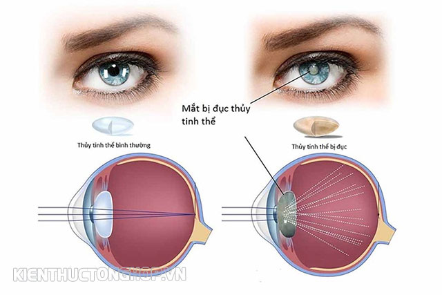 Đục thủy tinh thể mắt  - Nguyên nhân gây suy giảm thị lực